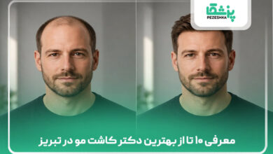 معرفی ۱۰ تا از بهترین دکتر کاشت مو در تبریز