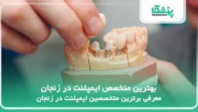 بهترین متخصص ایمپلنت در زنجان