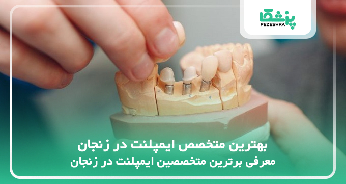 بهترین متخصص ایمپلنت در زنجان