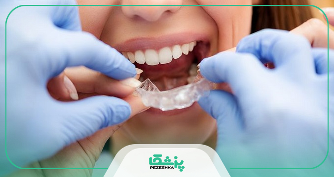 هر یک از انواع ارتودنسی چه مزیت هایی به همراه دارند ؟