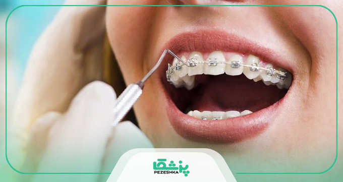 توصیه های بهترین دکتر ارتودنسی در شمال تهران