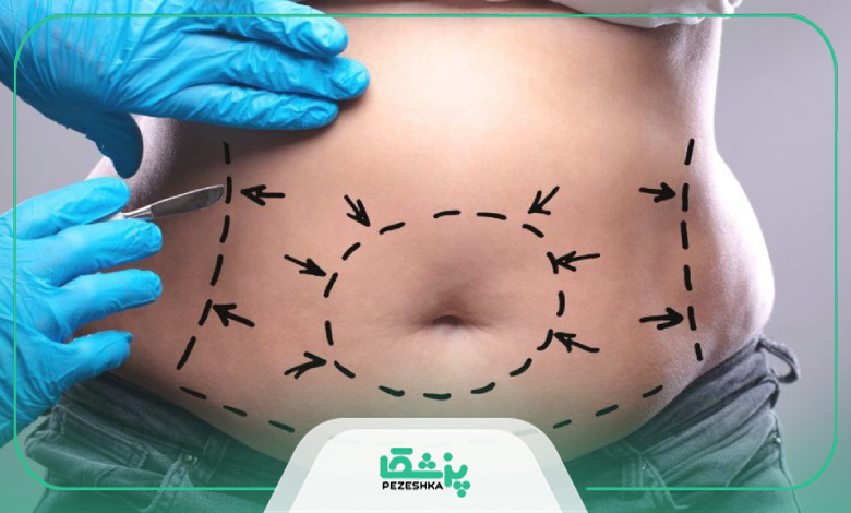 چگونه بهترین جراح ابدومینوپلاستی در شیراز را انتخاب کنیم؟