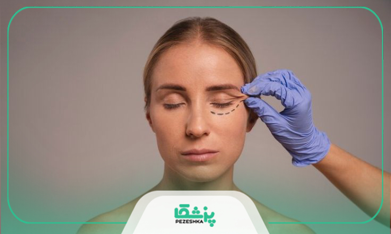 توصیه های لازم جهت انجام جراحی پلک