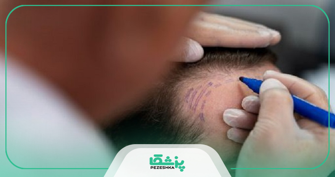 مزایا و کاندیدای مناسب کاشت مو