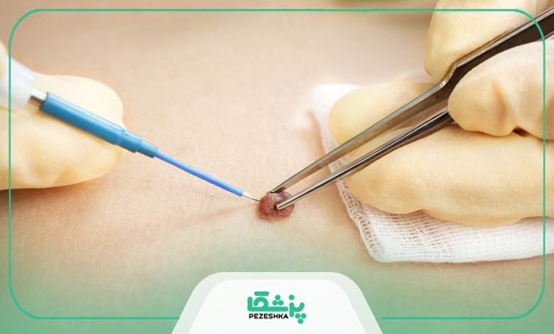 چه زمانی باید برای درمان زگیل تناسلی به پزشک مراجعه کنیم؟