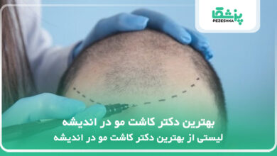 بهترین دکتر کاشت مو در اندیشه