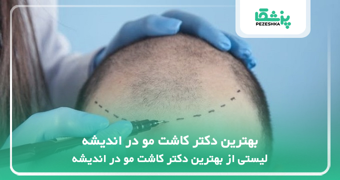 بهترین دکتر کاشت مو در اندیشه