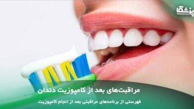 مراقبت های بعد از کامپوزیت دندان