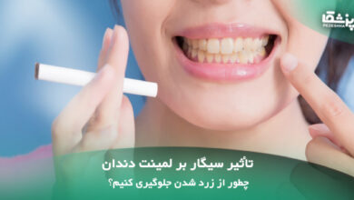 تأثیر سیگار بر لمینت دندان