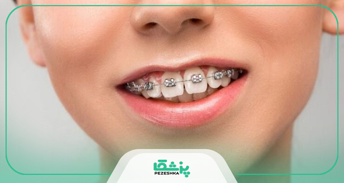 برای دندان‌های ارتودنسی‌شده، مسواک برقی بهتر است یا مسواک معمولی؟
