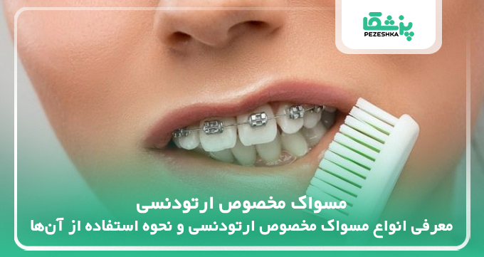 مسواک مخصوص ارتودنسی