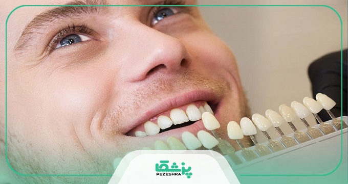 هزینه خدمات لمینت توسط بهترین دکتر لمینت دندان در ایران چقدر است؟