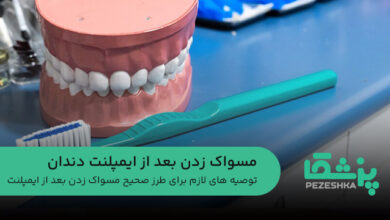 مسواک زدن بعد از ایمپلنت دندان