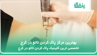 بهترین مرکز پاک کردن تاتو در کرج