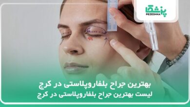 بهترین جراح بلفاروپلاستی در کرج
