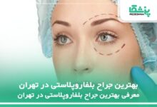 بهترین جراح بلفاروپلاستی در تهران