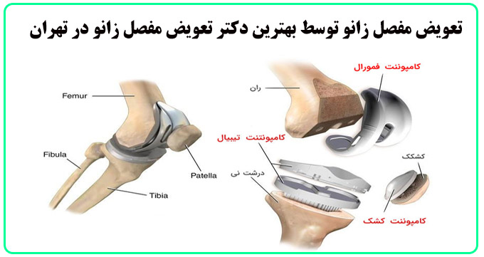 وظایف بهترین دکتر تعویض مفصل زانو در تهران