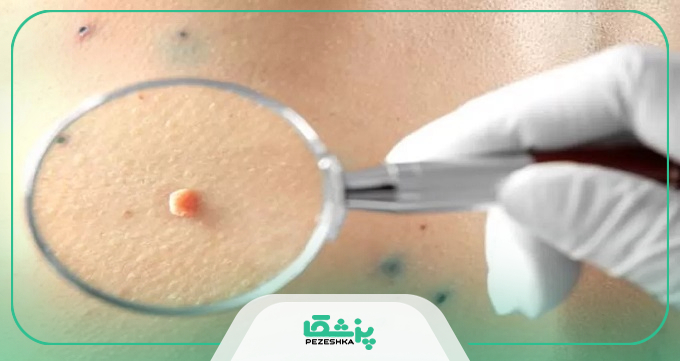 نقش واکسن HPV در جلوگیری از زگیل تناسلی و سرطان‌