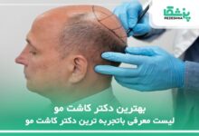 بهترین دکتر کاشت مو