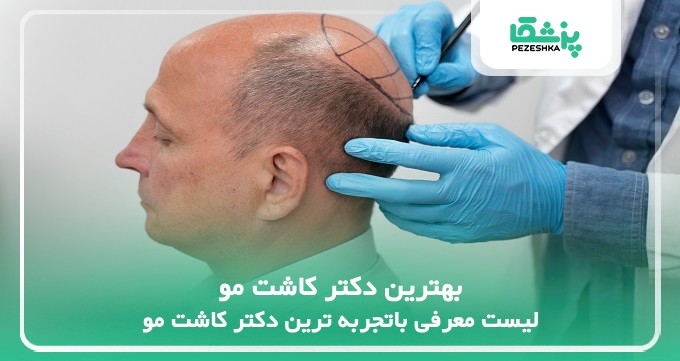بهترین دکتر کاشت مو
