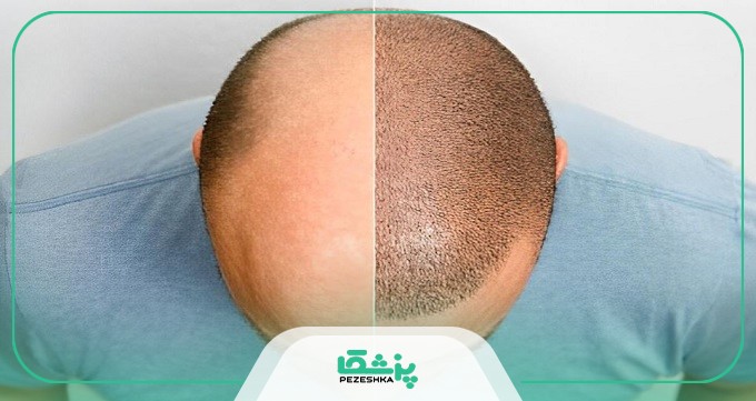 توصیه های مراقبتی بهترین متخصص کاشت مو