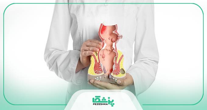 آیا هموروئید خطرناک است؟ بررسی عوارض و راه‌های پیشگیری