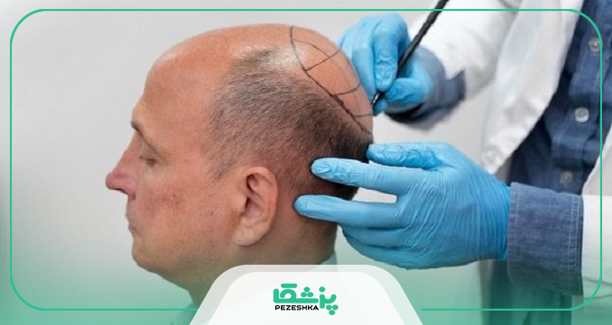 هزینه خدمات بهترین دکتر کاشت مو تهران چقدر است؟