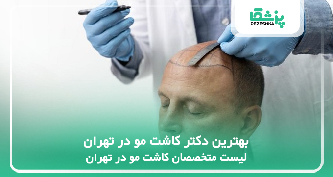 بهترین دکتر کاشت مو در تهران