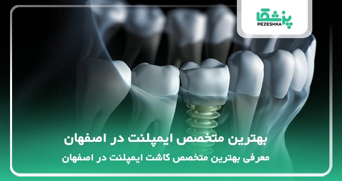 بهترین متخصص ایمپلنت در اصفهان