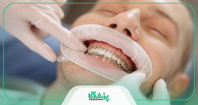 مراقبت‌ های ضروری هنگام استفاده از ارتودنسی