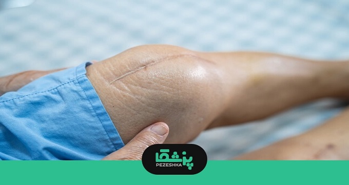 عوامل موثر بر طول عمر پروتز زانو