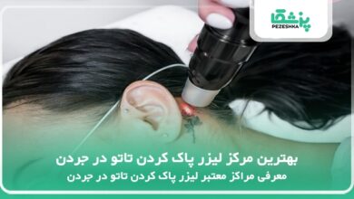 بهترین مرکز لیزر پاک کردن تاتو در جردن