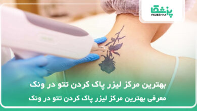 بهترین مرکز لیزر پاک کردن تتو در ونک