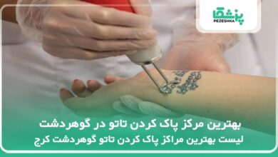 بهترین مرکز پاک کردن تاتو در گوهردشت