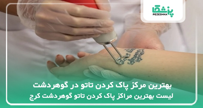 بهترین مرکز پاک کردن تاتو در گوهردشت
