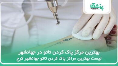 بهترین مرکز پاک کردن تاتو در جهانشهر