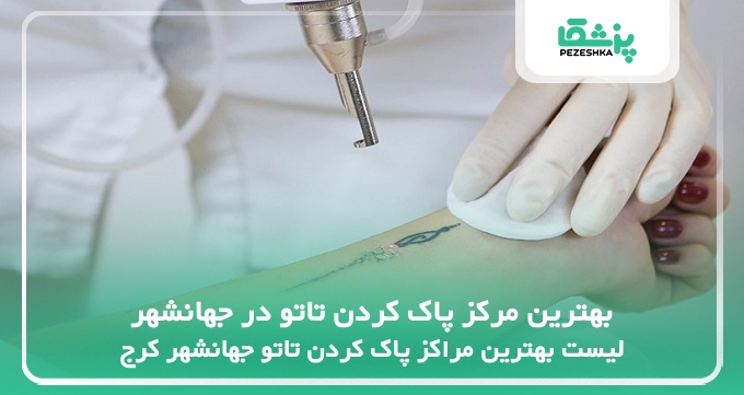 بهترین مرکز پاک کردن تاتو در جهانشهر