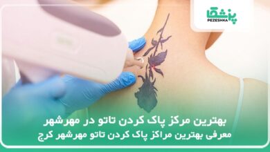 بهترین مرکز پاک کردن تاتو در مهرشهر