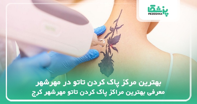 بهترین مرکز پاک کردن تاتو در مهرشهر