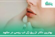 بهترین دکتر تزریق ژل لب روسی در مشهد