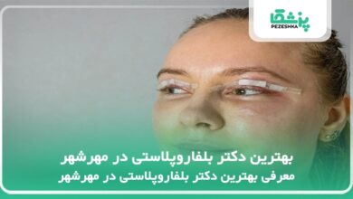 بهترین دکتر بلفاروپلاستی در مهرشهر