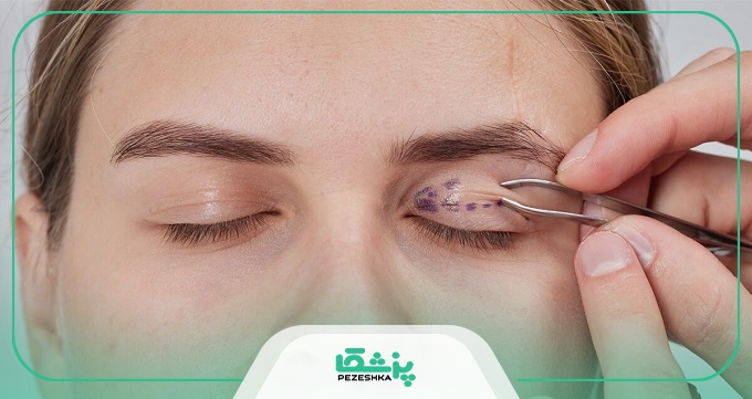 ویژگی بهترین دکتر بلفاروپلاستی در مهرشهر