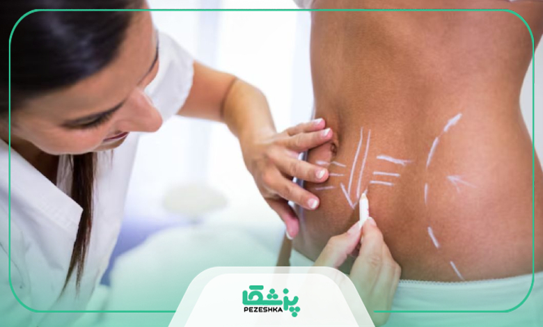 چگونه یک جراح مناسب برای پیکرتراشی انتخاب کنیم؟