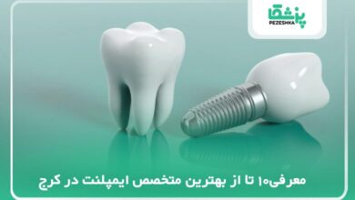 بهترین متخصص ایمپلنت در کرج