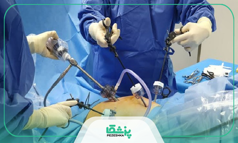 عوارض و خطرات لاپاراسکوپی زنان چیست؟