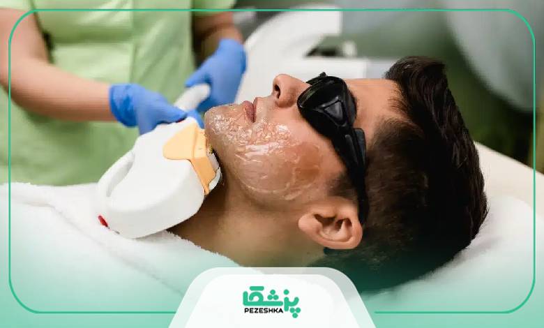 کاندیدای مناسب برای لیزر آقایان در شیراز