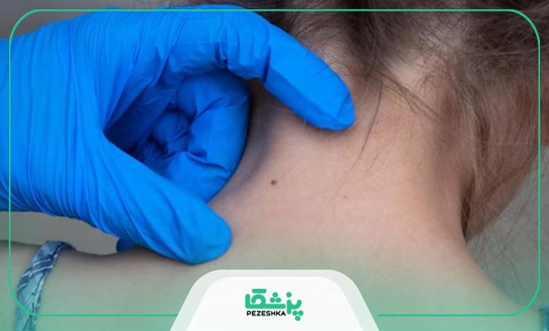 هزینه از بین بردن خال در بهترین مرکز برداشتن خال در پاسداران