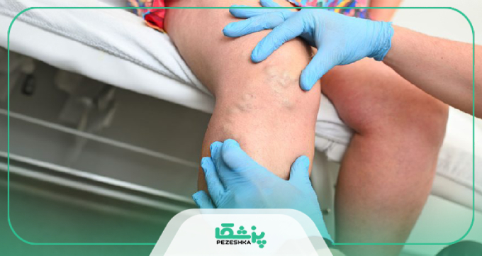 کاندیدای ایدهآل درمان نزد دکتر واریس پا