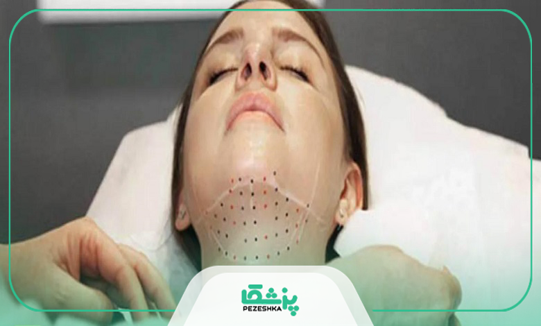 راهنمای انتخاب بهترین دکتر ساکشن غبغب در جوادیه