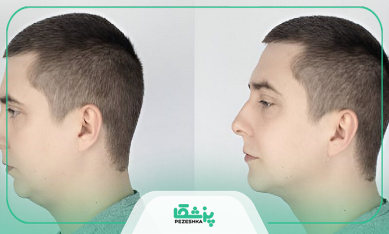 عوارض احتمالی ساکشن غبغب